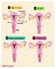 Siklus Menstruasi Pasca Melahirkan